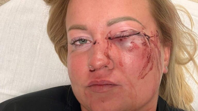 Bár nem lát rendesen, a látlelet szerint nyolc napon belül gyógyuló sérüléseket szenvedett az alpolgármester által leütött nő